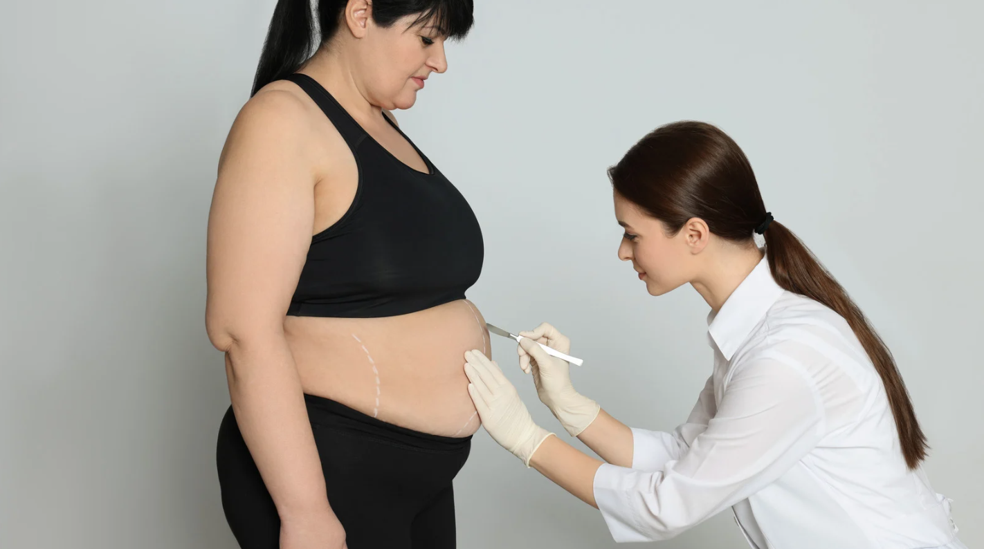 Cirurgia bariátrica pelo plano de saúde: o que é necessário para conseguir a liberação