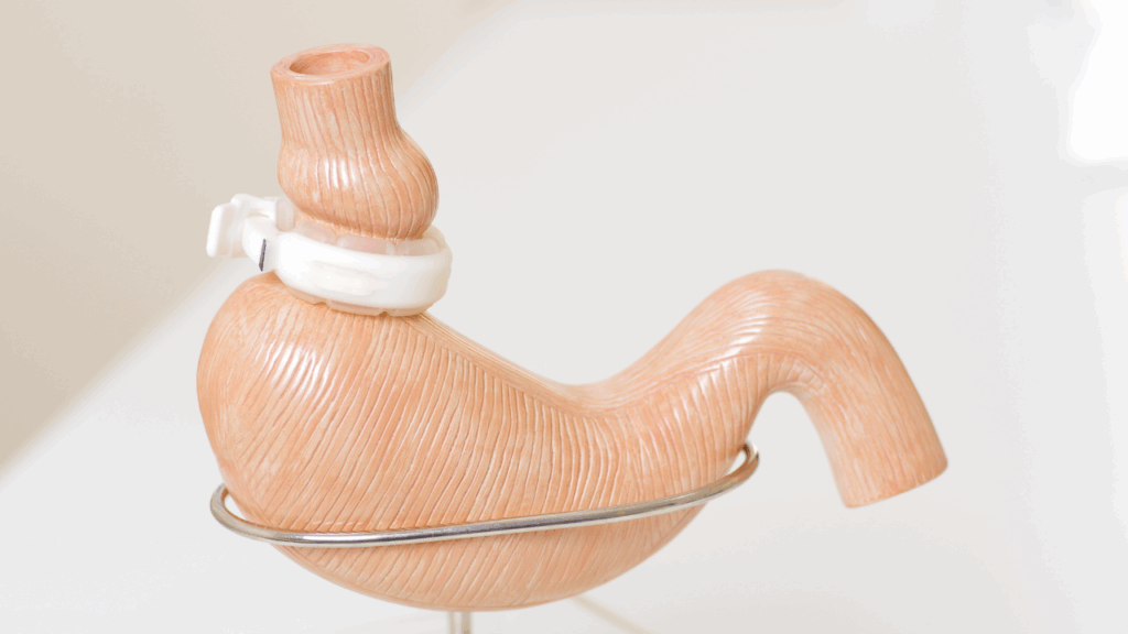 Plano Intermédica cobre cirurgia bariátrica? Descubra como solicitar a autorização