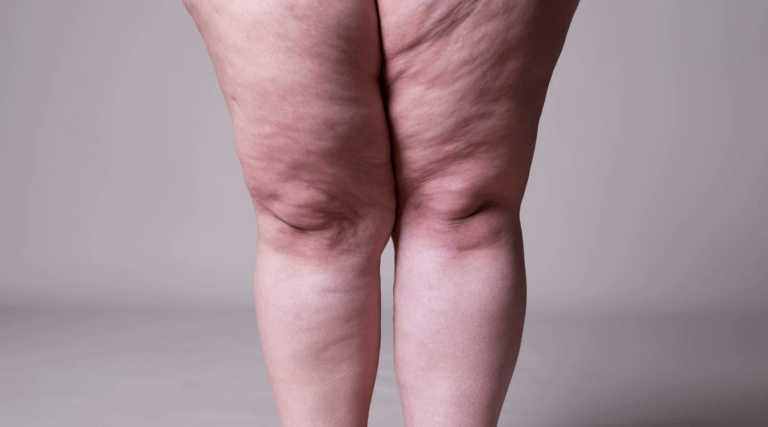 Tratamento de Lipedema com Mounjaro e Dieta Anti-inflamatória